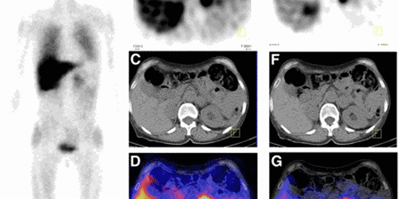 SPECT CT Scan Image Voorbeeld Www.Curiumpharma.Com Nl Producten